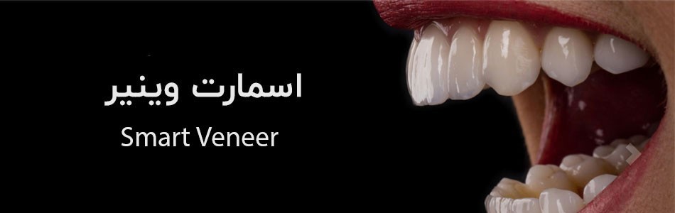  اسمارت وینیر Biomimitic Smart Veneer چیست؟ 